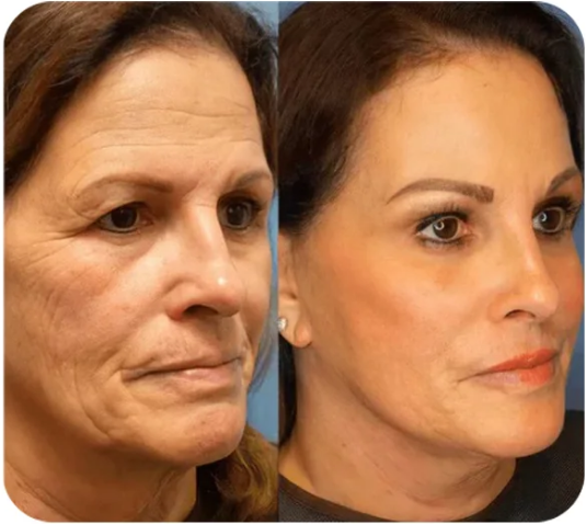 Last Day Discount: 87% OFF 🌸Instant face Tightener No-Filter Primer
