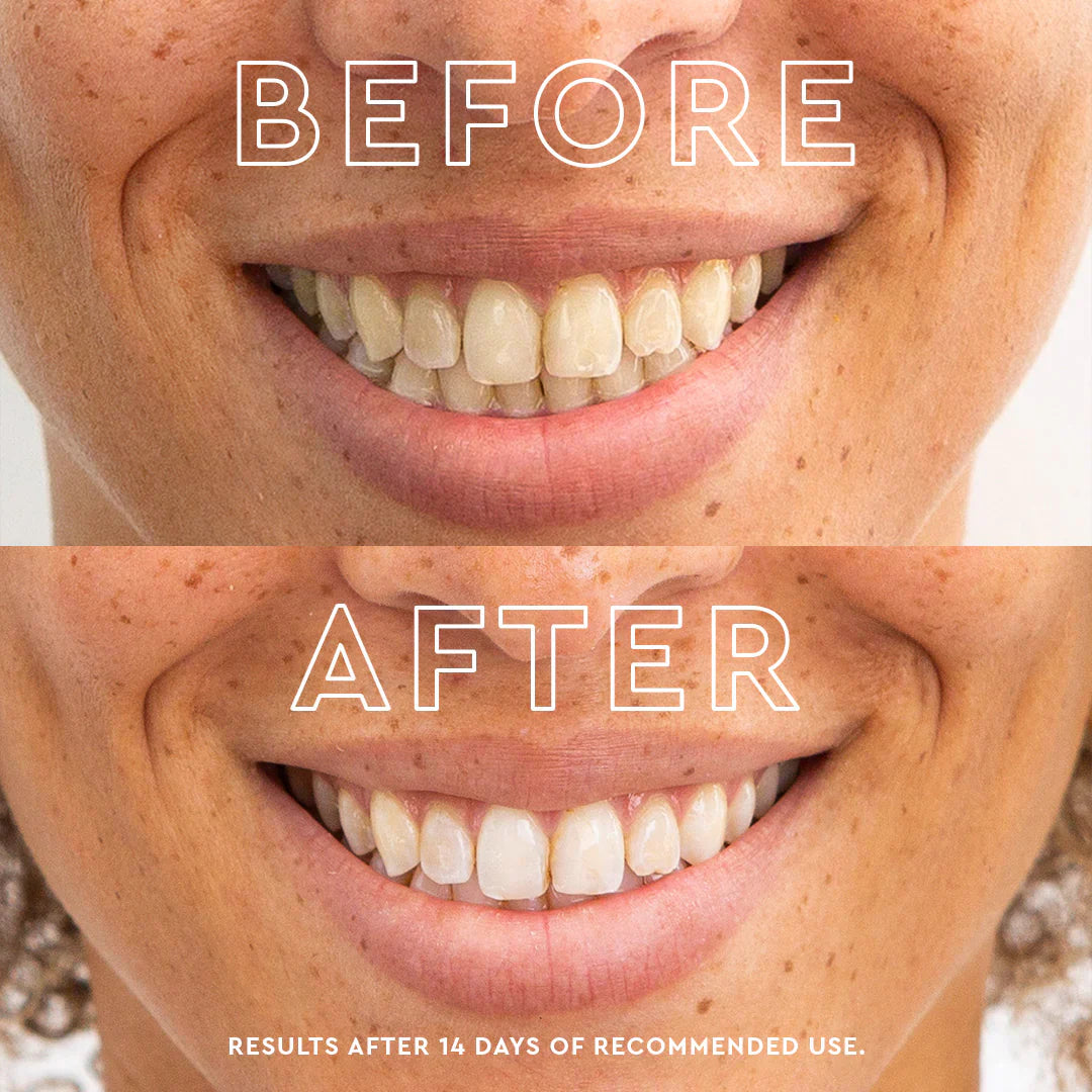 🔥60% OFF LOVILDS™ Remove yellow stains, whiten teeth, achieve quick whiteness. One-time whitening tooth patch for fast tooth whitening.