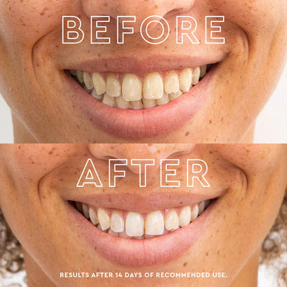 🔥60% OFF LOVILDS™ Remove yellow stains, whiten teeth, achieve quick whiteness. One-time whitening tooth patch for fast tooth whitening.