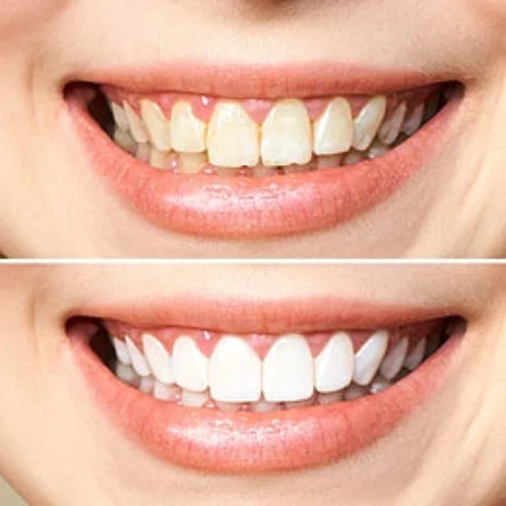 👑LAST DAY UP TO 70% off:Insideefy ™ smiles new upgraded automatic self-brushing toothbrush