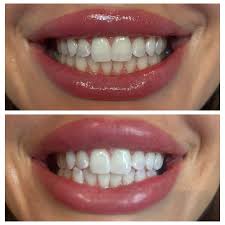 🔥60% OFF LOVILDS™ Remove yellow stains, whiten teeth, achieve quick whiteness. One-time whitening tooth patch for fast tooth whitening.