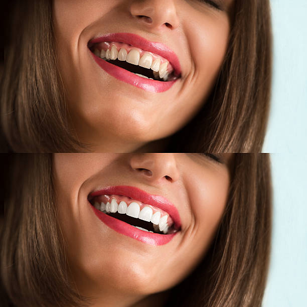 🔥60% OFF LOVILDS™ Remove yellow stains, whiten teeth, achieve quick whiteness. One-time whitening tooth patch for fast tooth whitening.